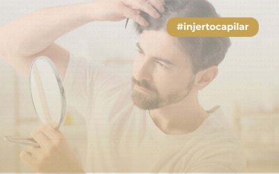 ¿Cómo funciona el injerto capilar para mejorar tu aspecto? Beneficios y riesgos