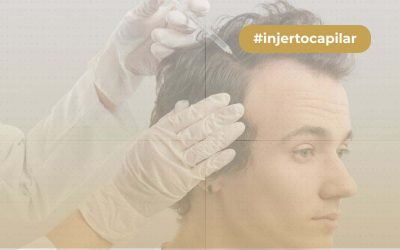 ¿Qué es la mesoterapia capilar?