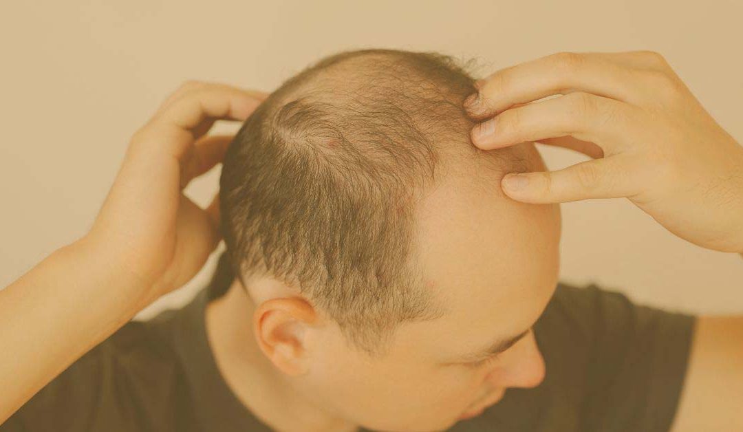Alopecia Androgénica