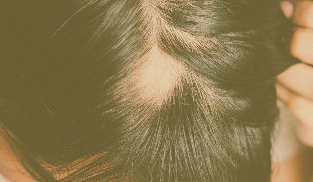Alopecia Areata