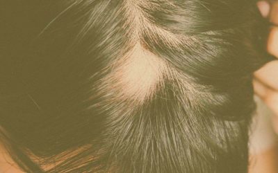 Alopecia Areata