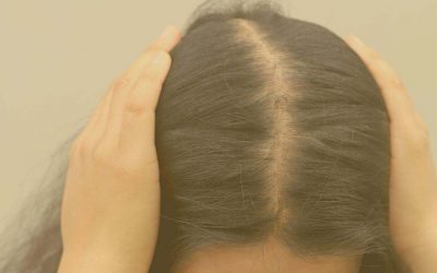 Alopecia Difusa